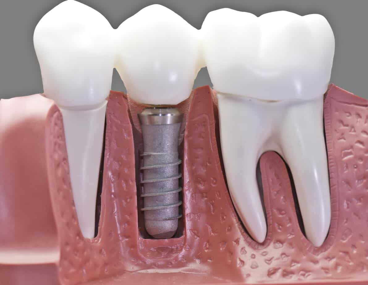 Dental Implants Depositphotos 4287971 ds