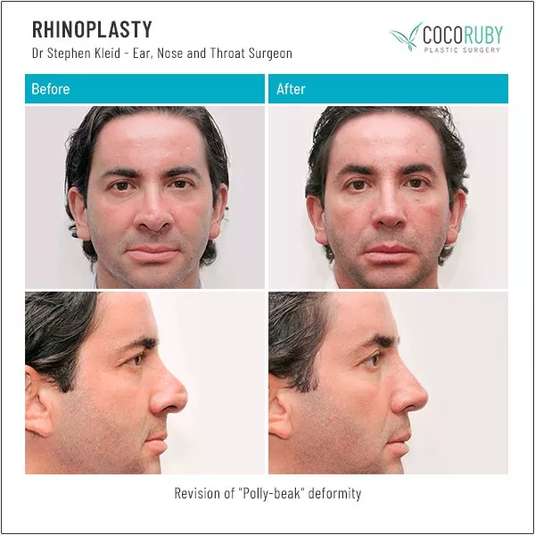 dr stephen kleid rhinoplasty 6.jpg