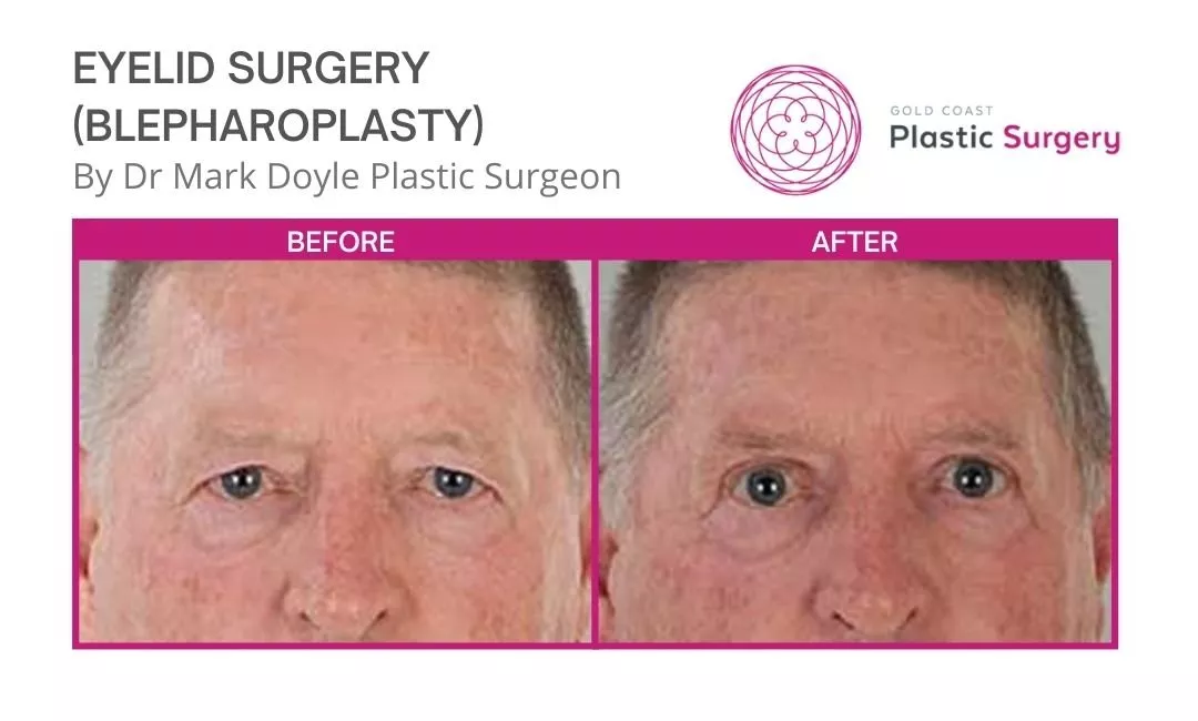 eyelid surgery before and after brisbane.jpg