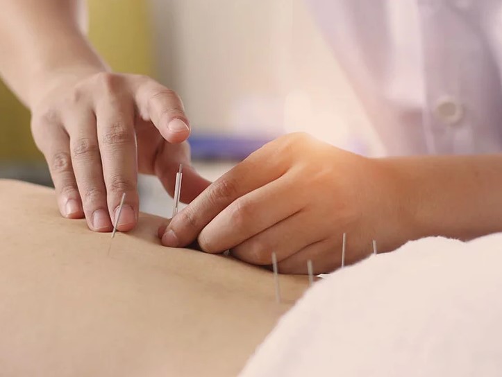 Does Medicare Part B Cover Acupuncture